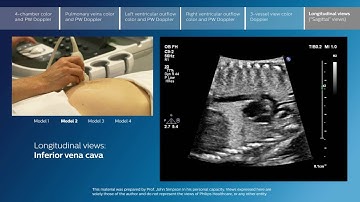 Advanced screening views of the fetal heart - Part 6 - Longitudinal views