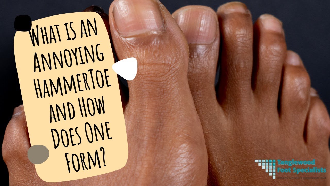 Houston Hammer Toe Treatment Specialist Mallet Toe Claw Toe