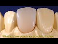 Complete Guide to Long-Lasting Dental Crowns | Jain's Dental Villa