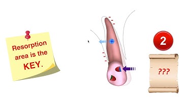 Screws for fixed appliances and aligners 2020 AAO Part II｜【Chris Chang Ortho】CC550