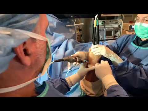 Wrist Arthroscopy on Patient with Ulnar Sided Wrist Pain