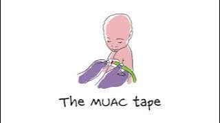 Muac tape to detect malnutrition easily
