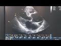 ضغط عالى ادى الى تمدد فى شرايين القلب. Hypertension causing ASCENDING AORTIC DILATATION