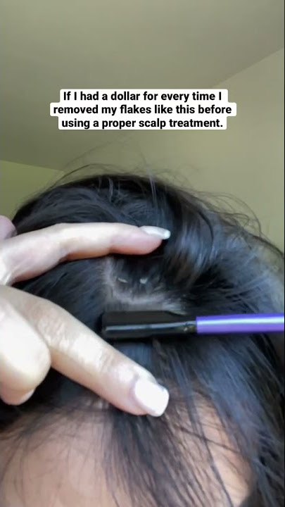Dermatitis Seboroik | Act Acre