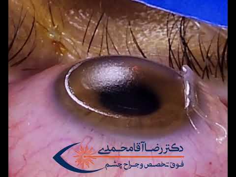 عمل فمتو لیزیک از نمای نزدیک