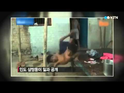 하반신 공유한 인도 샴쌍둥이 일과 보니… / YTN