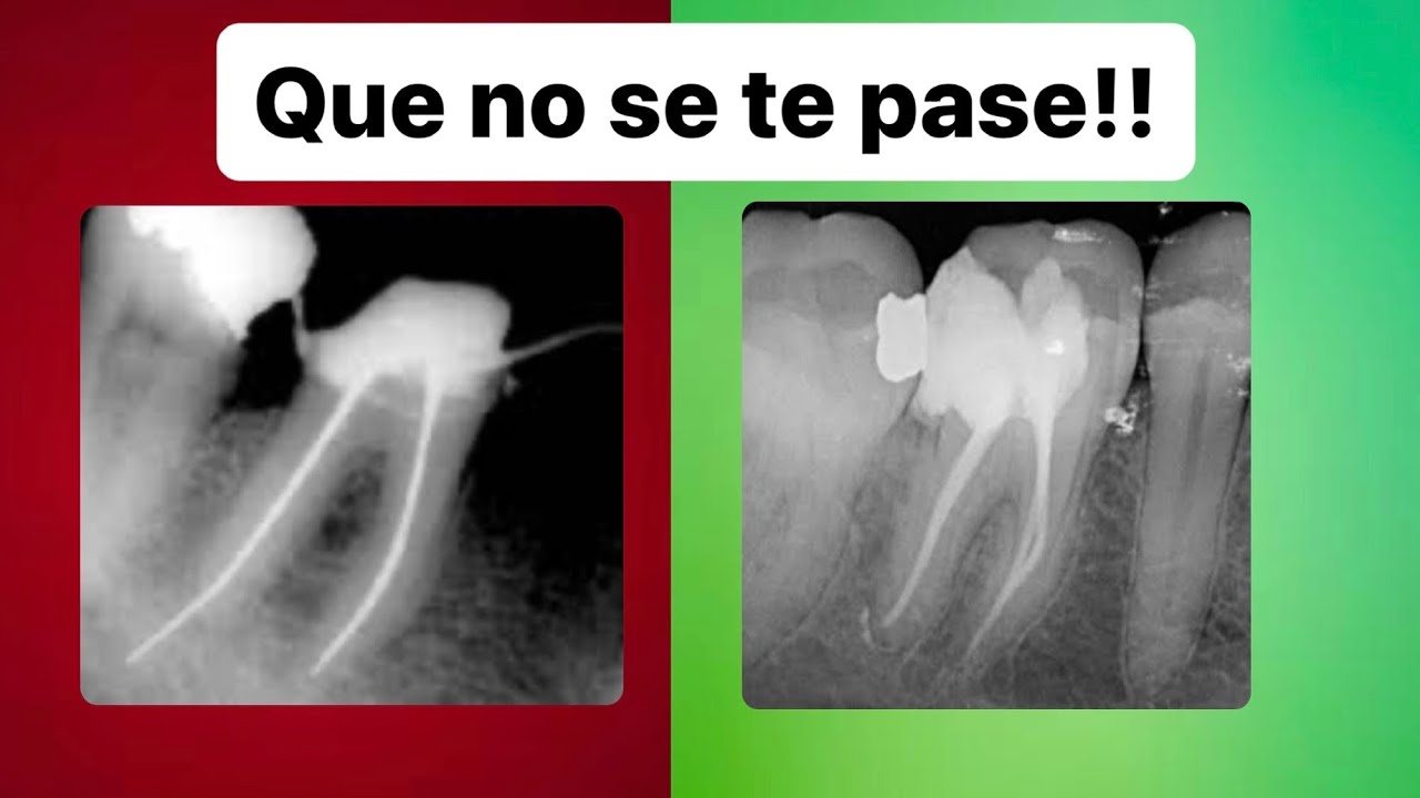 Tug Back - Ajuste apical del cono Maestro