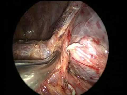 Video: Systematisk Gennemgang Og Metaanalyse Af Videoassisteret Thoracoskopisk Kirurgi Segmentektomi Versus Lobektomi For Fase I Ikke-småcellet Lungekræft