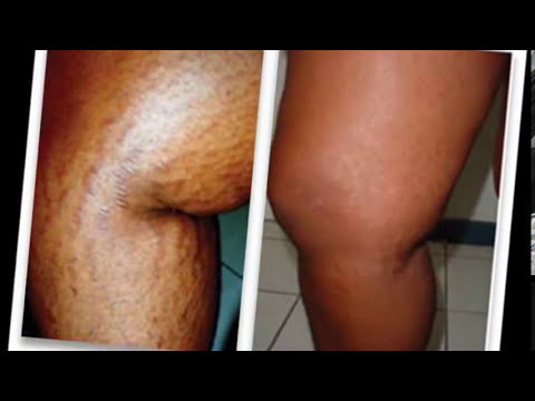 Amazing Cream Eliminates Pregnancy stretch marks! - YouTube