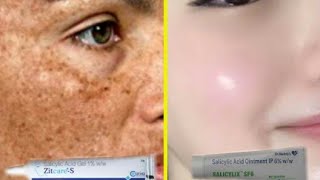 Salicylic acid cream | Remove Pigmentation | Dark spot | Acne & Acne scars | Brijwasi Girl