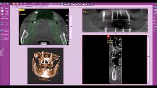 Dantų implantacija. Dantų atkūrimas ant implantų &quot;Papadent&quot; klinikoje.