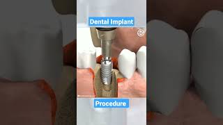 Dental Implant Procedure #dental #dentist #implant #animation #Shorts