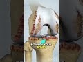 Kneepain #orthopedics #orthopedicsurge #totalkneereplacementsurgery #ytshorts