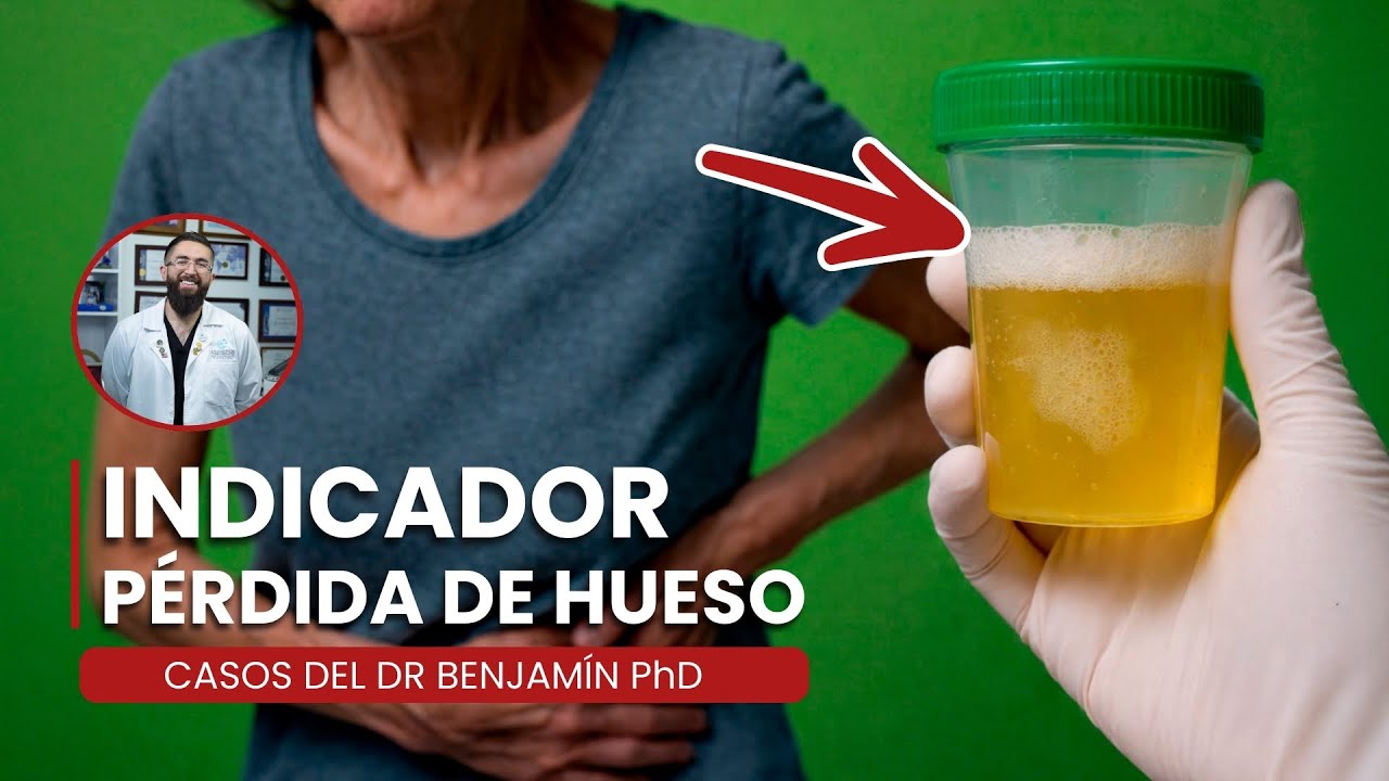 La Espuma en la Orina puede ADVERTIR Osteoporosis GRAVE - Casos del Dr Benjamín PhD