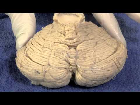 Vestibular System: Neuroanatomy Video Lab - Brain Dissections