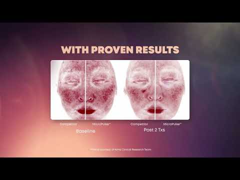 Alma, a global leader in the energy-based medical and aesthetic solutions industry, proudly announces the commercial availability of Alma Veil™. This advanced, dual-wavelength vascular laser workstation establishes a new standard in excellence by optimizing efficiency with remarkable efficacy across a comprehensive range of vascular and dermatological conditions.
Alma Veil is the core instrument equipped with three gold-standard technologies conveniently integrated into a single handpiece:
• 532 Alma, a global leader in the energy-based medical and aesthetic solutions industry, proudly announces the commercial availability of Alma Veil™. This advanced, dual-wavelength vascular laser workstation establishes a new standard in excellence by optimizing efficiency with remarkable efficacy across a comprehensive range of vascular and dermatological conditions.
Alma Veil is the core instrument equipped with three gold-standard technologies conveniently integrated into a single handpiece:
• 532