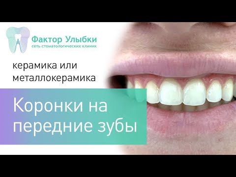 Коронки на передние зубы - какие поставить?