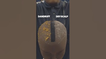 Dry Scalp vs. Dandruff: Identifying and Treating the Differences