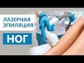 Лазерная эпиляция ног - что нельзя делать после процедуры