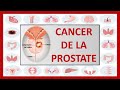 🔴UROLOGIE : CANCER DE LA PROSTATE l'adénocarcinome prostatique