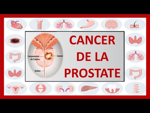 Vidéo: Cancer De La Prostate (adénocarcinome) Chez Le Chat