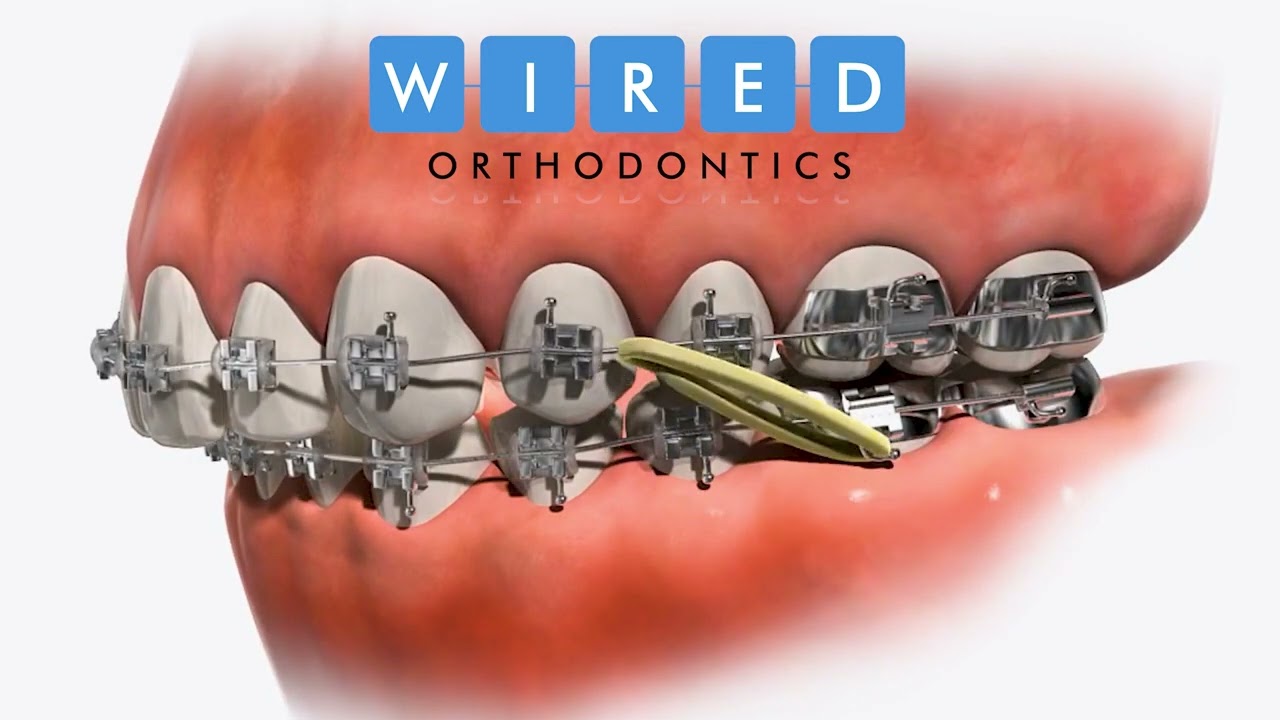 Elastic Class II | Wired Orthodontics