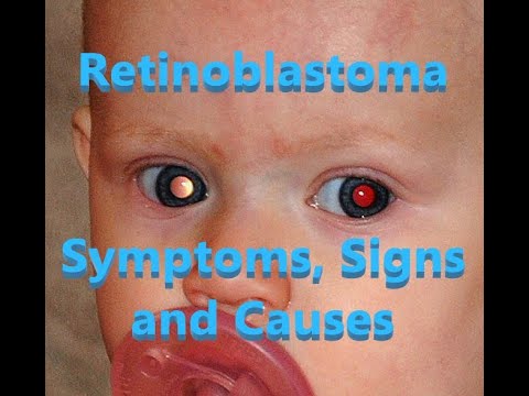 रेटिनोब्लास्टोमा - लक्षण, संकेत और कारण