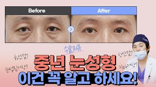 중년 눈성형 리뷰ㅣ 사나운 인상 안 되려면 하기 전 꼭 보세요!