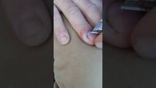 Infected cuticle on finger ( Paronychia )