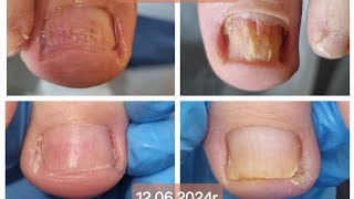 Grzybica Paznokci - Zobacz Różnicę ?