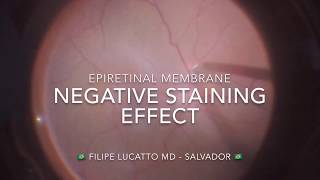 Negative staining effect - Author: Filipe Lucatto MD