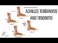 Achilles tendinosis and tendinitis: Signs, symptoms and treatment options