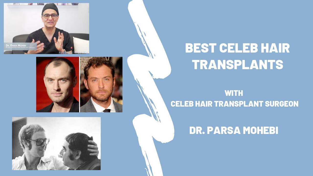 Top 3 Best Celebrity Hair Transplants - Parsa Mohebi Hair Restoration -  Parsa Mohebi Hair Restoration