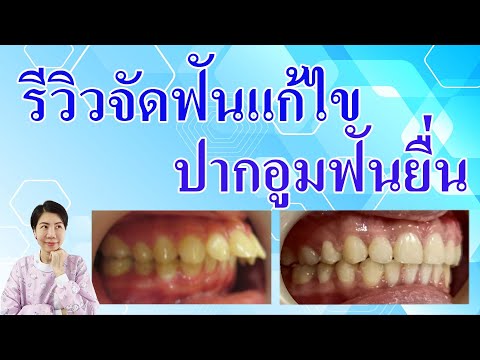 รีวิวจัดฟันแก้ไขฟันยื่น ปากอูม