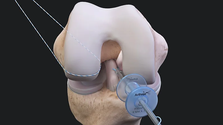 ACL Recovery FAQs ACLTear.com