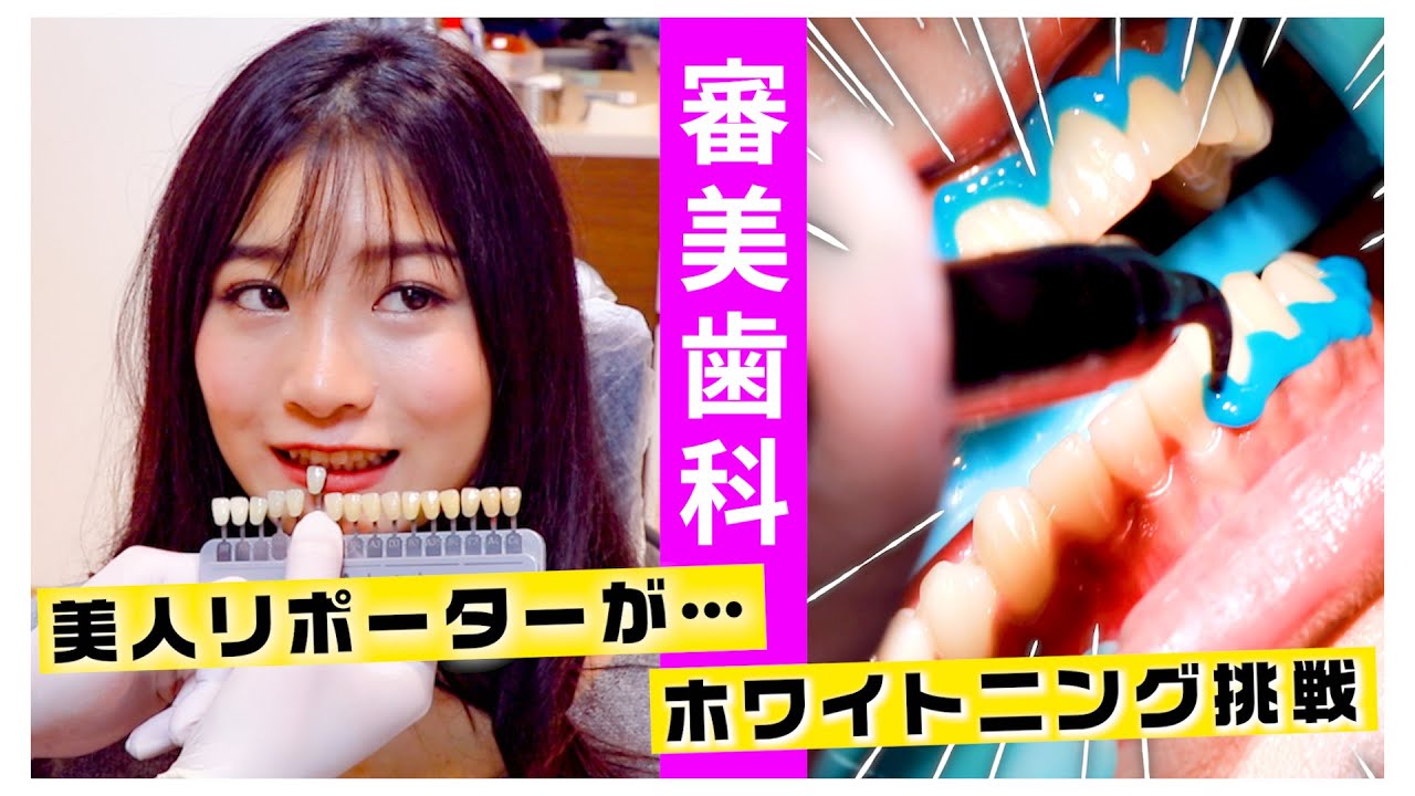 15年ぶりの 歯医者 ！？銀座の高級 歯医者 で ホワイトニング 体験！！ 歯石 も徹底的に除去！！マウスピースの先進技術もご紹介♪