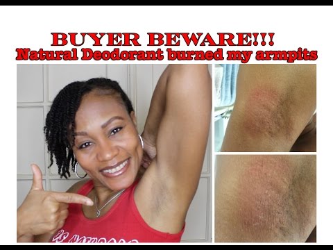 When Natural Deodorant Goes Wrong You - Arm And Hammer Natural Deodorant Rash When Natural Deodorant Goes Wrong You - Arm And Hammer Natural Deodorant Rash