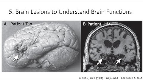 2.5. Lesions to Understand Brain Functions, Fundamentals of Cognitive Neuroscience, Session 2, P5