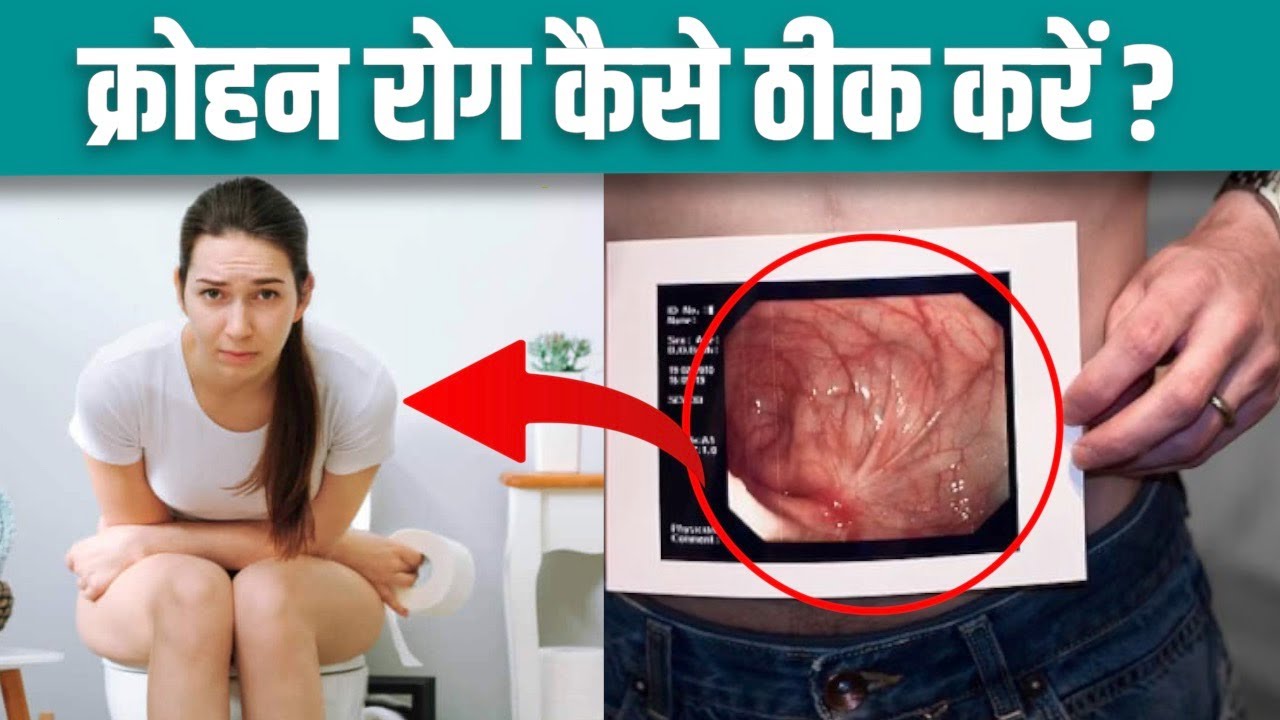 क्रोहन रोग कैसे ठीक करें Crohn Disease Treatment Symptoms In Hindi
