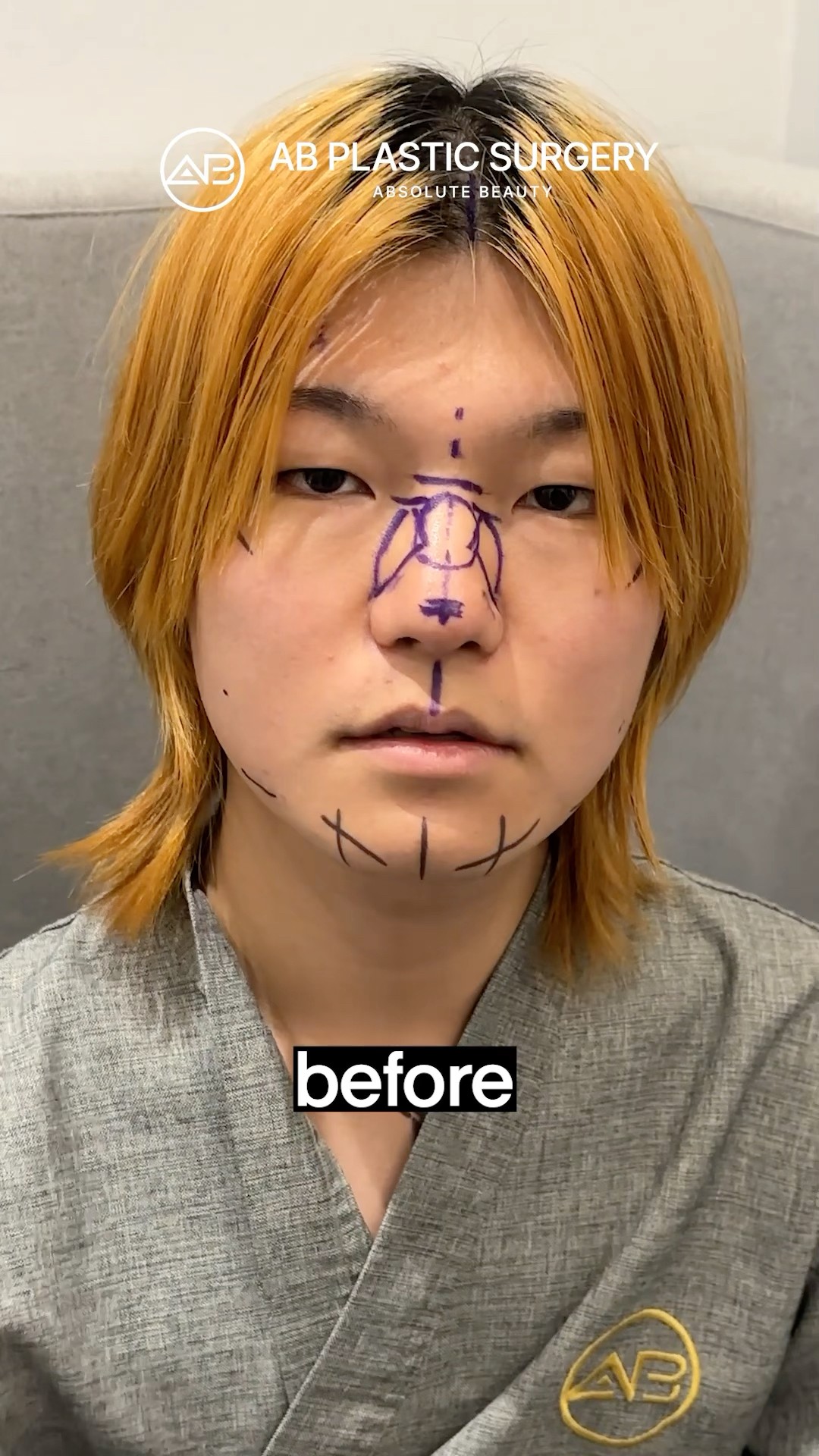 MTF Facial Feminization Dramatic Transformation! #koreanplasticsurgery