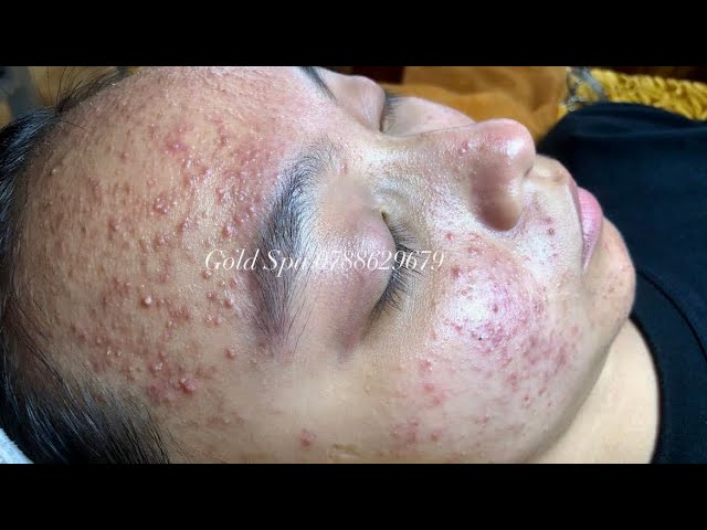 Huyen phan treantment acne #110 #acne #mun #nanmun #goldspa