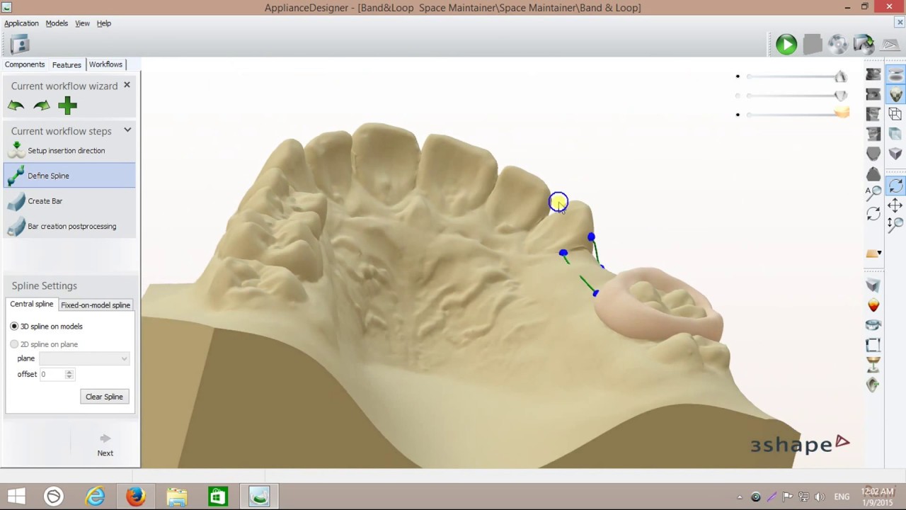 Digital Band & Loop Space Maintainer Design YouTube