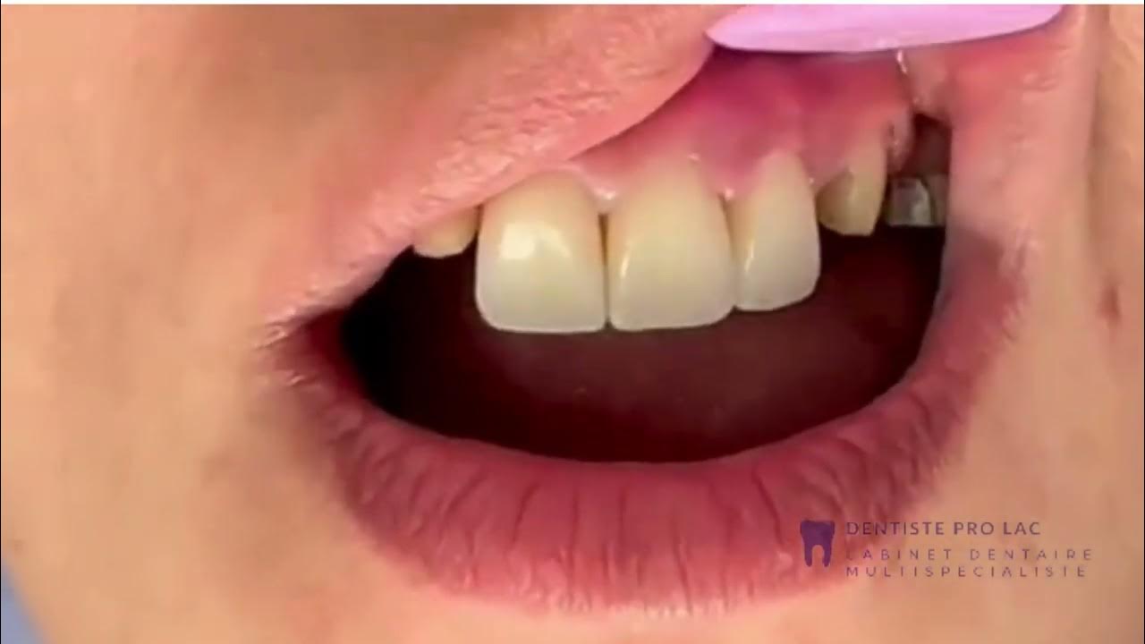 Une transformation radicale grâce aux couronnes dentaires pour les dents de devant Avant et