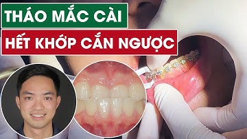 Tháo mắc cài hết móm | Thành quả sau 20 tháng đeo mắc cài niềng răng