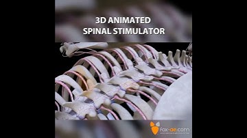 Spinal Cord Stimulator Animation