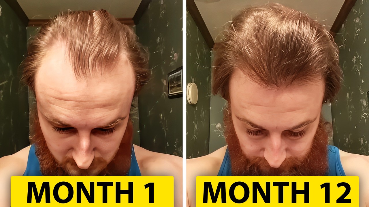 How To Reverse Hair Loss In 12 Months