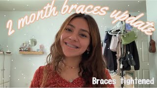 ✰ 2 month braces update✰