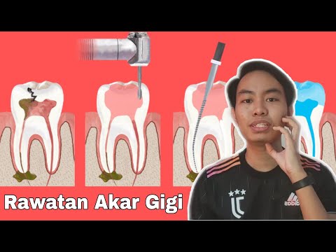 Pengalaman buat Rawatan Akar Gigi