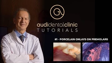 ONLAYS - Episode 2 - How to prepare and place porcelain onlays on premolars
