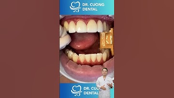 Răng Thưa Không Muốn Niềng Thì Làm Gì? | Dr Cường Official